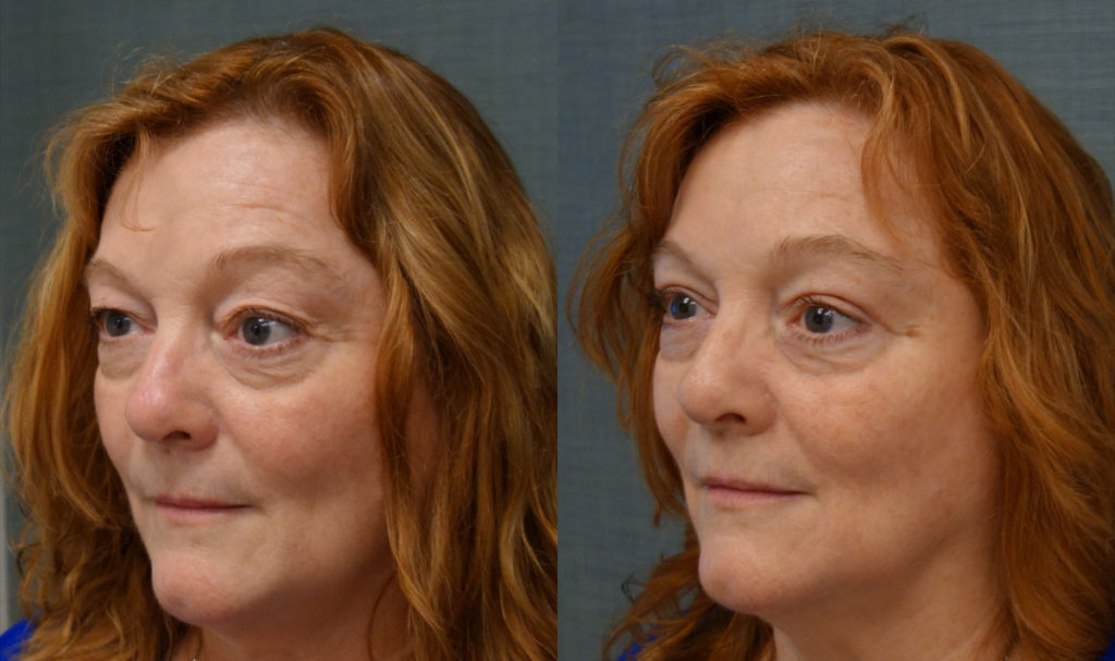 Bilateral Upper Eyelid Blepharoplasty Patient 57-C 