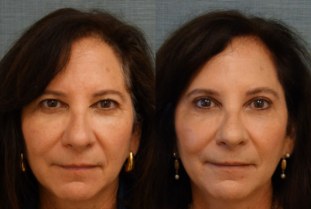 Bilateral Upper Eyelid Blepharoplasty, Bilateral Mini Brow Lift Patient 58-A 