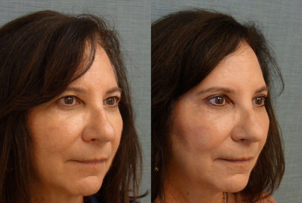 Bilateral Upper Eyelid Blepharoplasty, Bilateral Mini Brow Lift Patient 28-B 