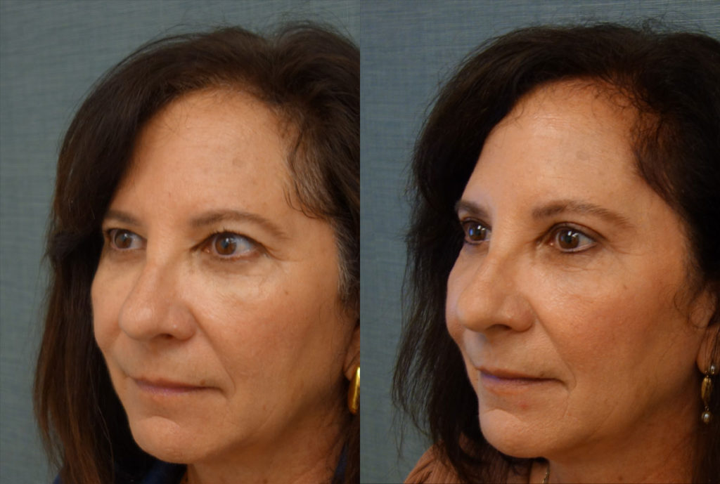 Bilateral Upper Eyelid Blepharoplasty, Bilateral Mini Brow Lift Patient 28-C 