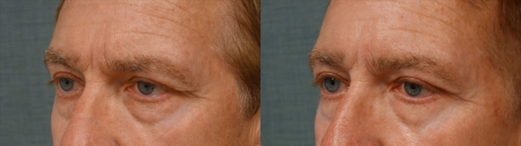 Bilateral Upper Eyelid Blepharoplasty, Bilateral Upper Eyelid Internal Ptosis Repair Patient 59-C 