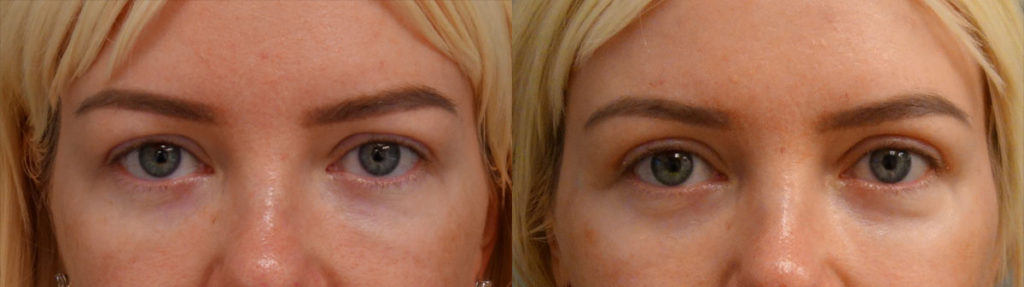 Bilateral Upper Eyelid Blepharoplasty, Chemical Peel to Bilateral Lower Eyelids Patient 61-A 