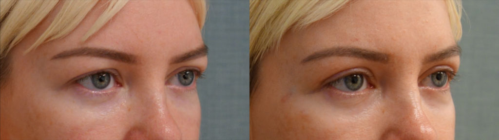 Bilateral Upper Eyelid Blepharoplasty, Chemical Peel to Bilateral Lower Eyelids Patient 61-B 