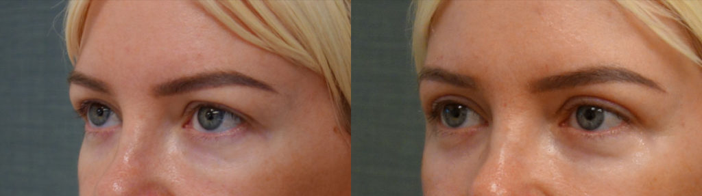 Bilateral Upper Eyelid Blepharoplasty, Chemical Peel to Bilateral Lower Eyelids Patient 61-C 