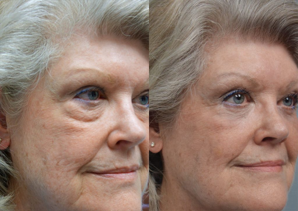 Lower Eyelid Blepharoplasty with Internal cheek Elevation Patient 23-B 