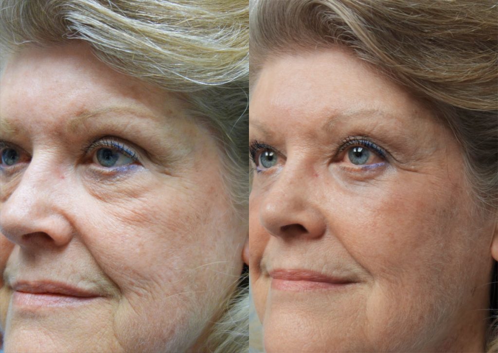 Lower Eyelid Blepharoplasty with Internal cheek Elevation Patient 23-C 