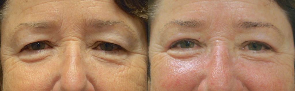 Bilateral Upper Eyelid Blepharoplasty (No Brow) Patient 02-A 
