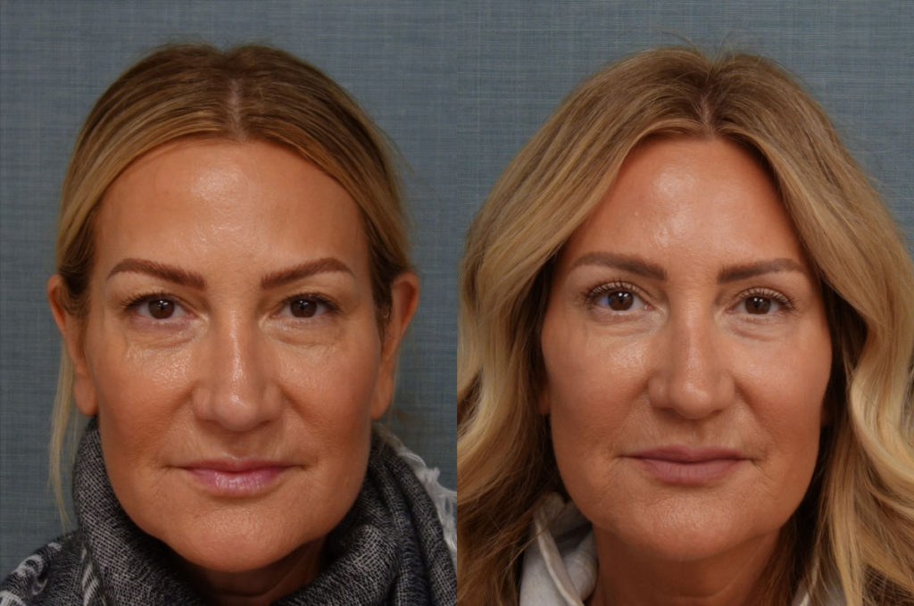 Bilateral Upper Eyelid Blepharoplasty, Chemical Peel to Bilateral Lower Eyelids Patient 54-A 