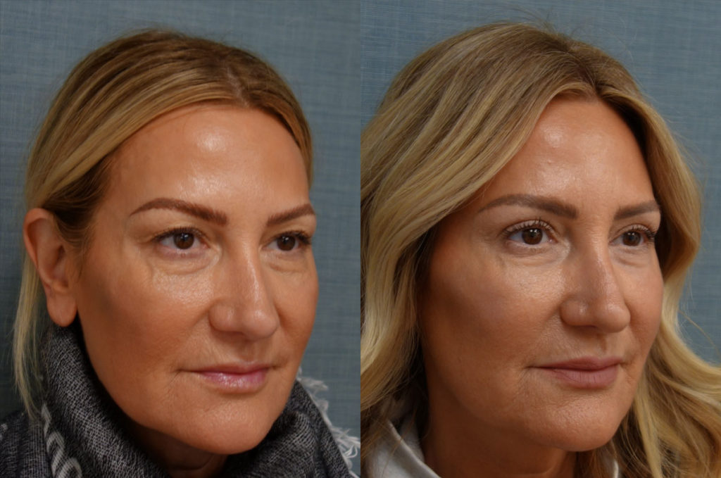 Bilateral Upper Eyelid Blepharoplasty, Chemical Peel to Bilateral Lower Eyelids Patient 54-B 