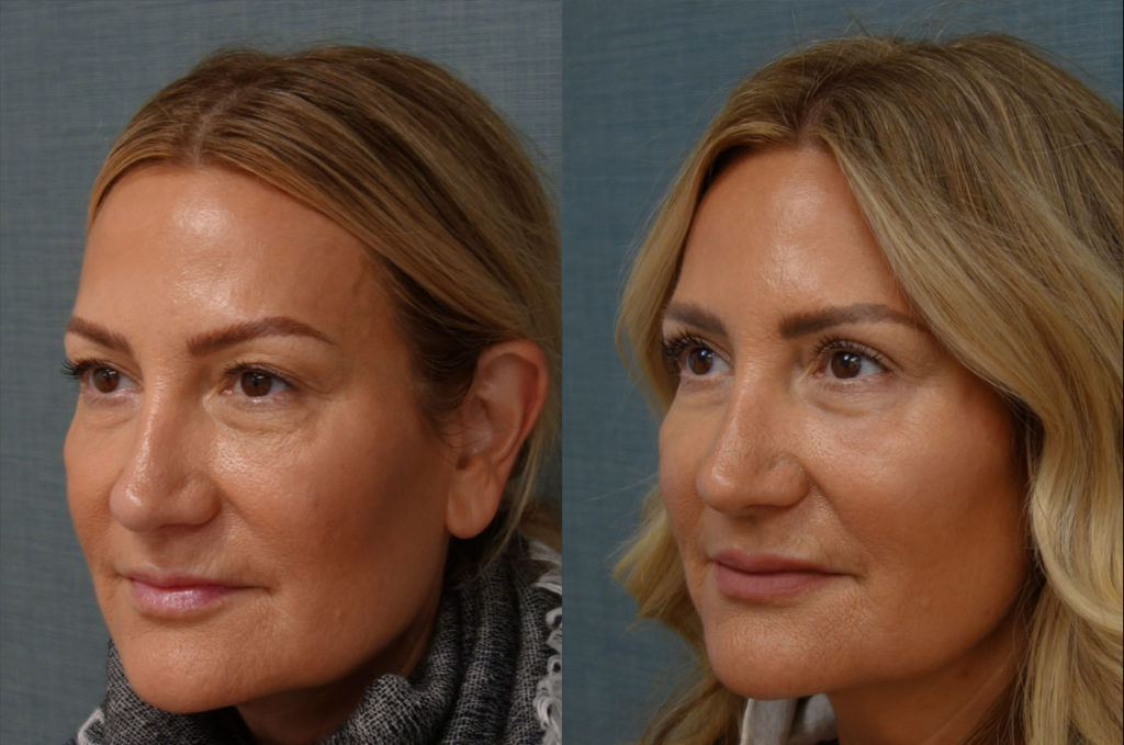 Bilateral Upper Eyelid Blepharoplasty, Chemical Peel to Bilateral Lower Eyelids Patient 54-C 