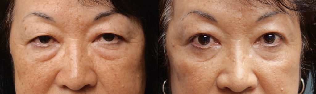 Asian Upper Eyelid and Lower Eyelid Blepharoplasty Patient 32-A 