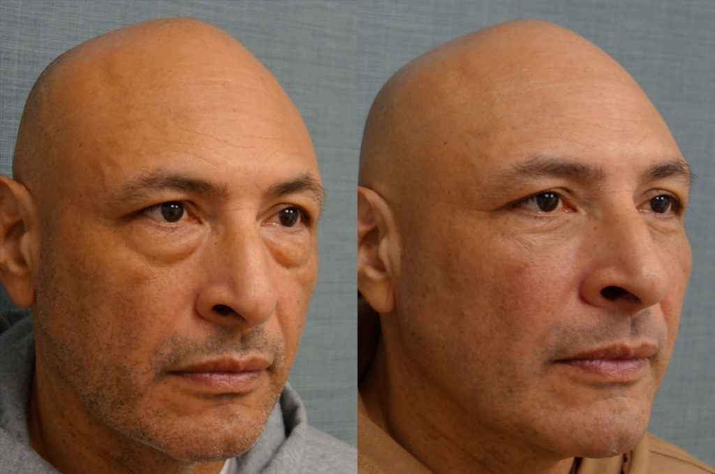 Lower Eyelid Blepharoplasty with Internal Cheek Elevation Patient 35-B 