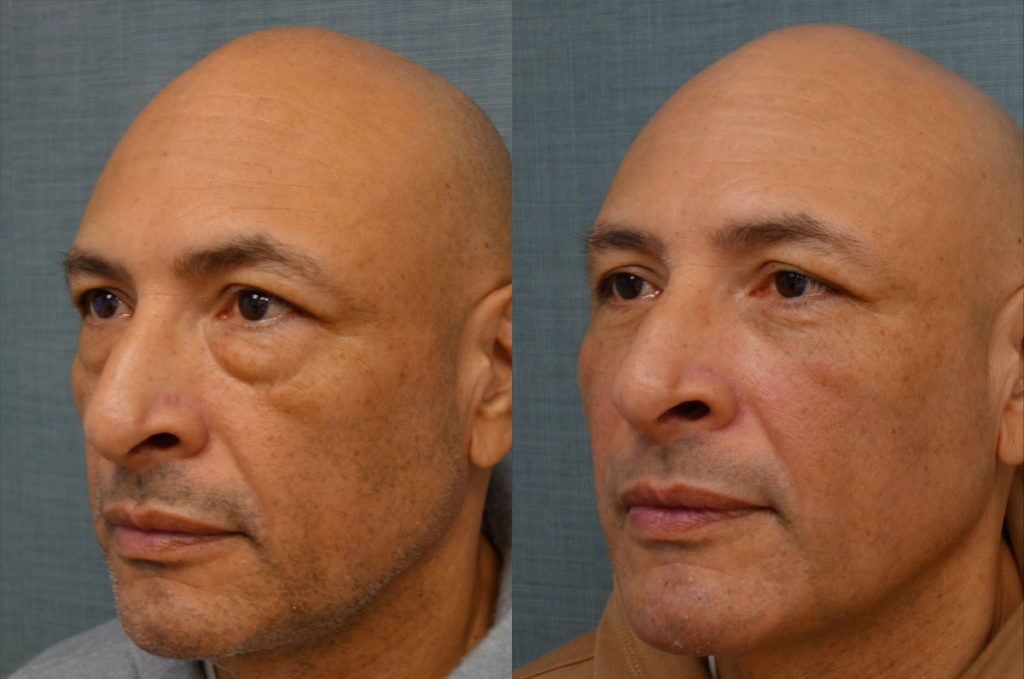 Lower Eyelid Blepharoplasty with Internal Cheek Elevation Patient 35-C 