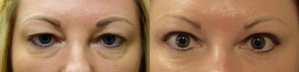 Upper and Lower Eyelid Blepharoplasty Patient 38-A 