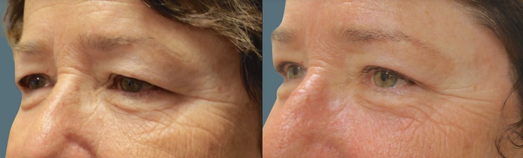 Upper Eyelid Blepharoplasty Patient 40-C 