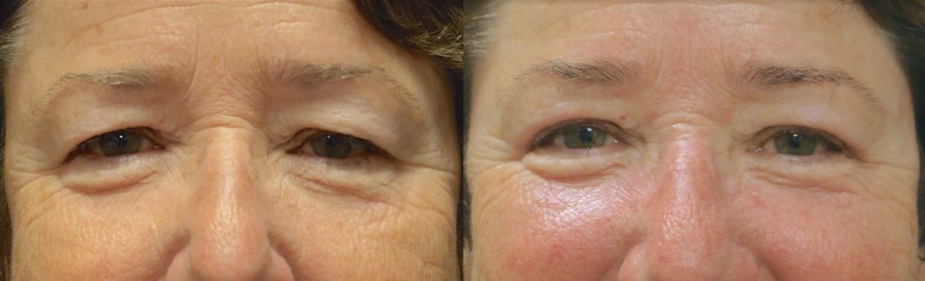 Upper Eyelid Blepharoplasty Patient 40-A 