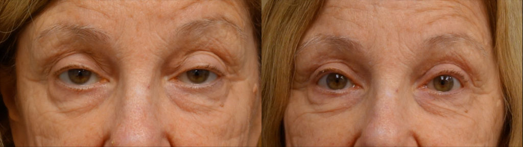 Upper Eyelid Blepharoplasty, Bilateral Upper Eyelid External Ptosis Repair Patient 18-A 