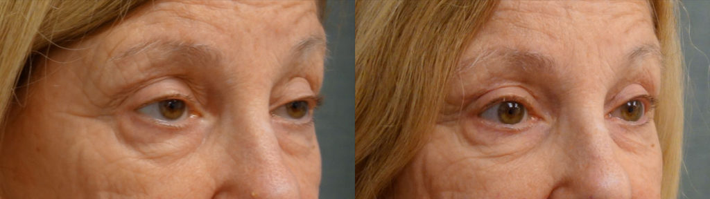 Upper Eyelid Blepharoplasty, Bilateral Upper Eyelid External Ptosis Repair Patient 18-B 