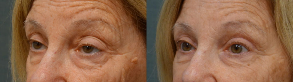 Upper Eyelid Blepharoplasty, Bilateral Upper Eyelid External Ptosis Repair Patient 18-C 