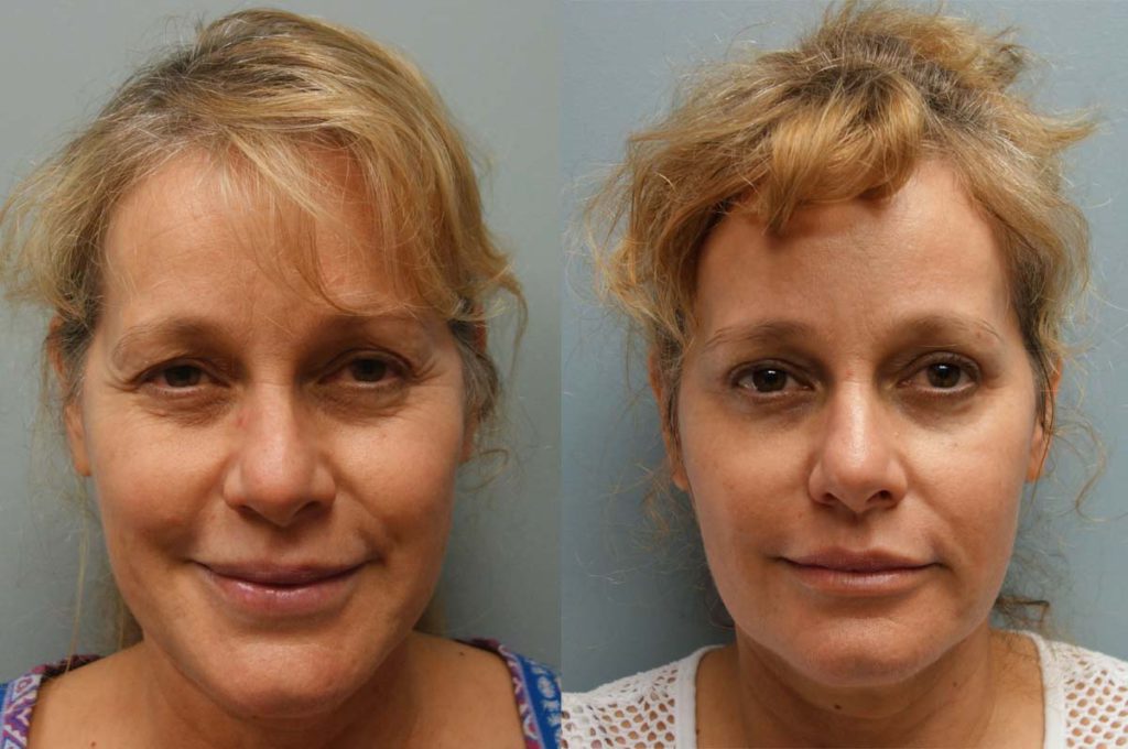 Upper Eyelid Blepharoplasty, Mini Brow Lift and Laser Resurfacing Patient 39-A 