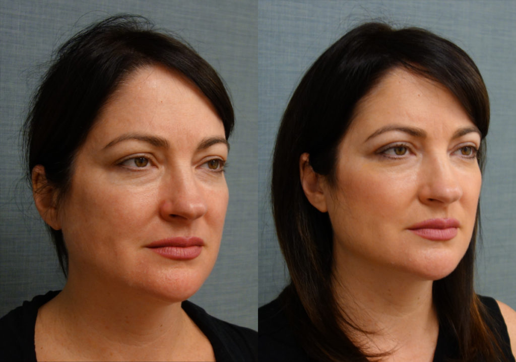 Bilateral Upper Eyelid Blepharoplasty, FaceTite With Micro-Liposuction, Morpheus Microneedling Lower Face Patient 34-A 