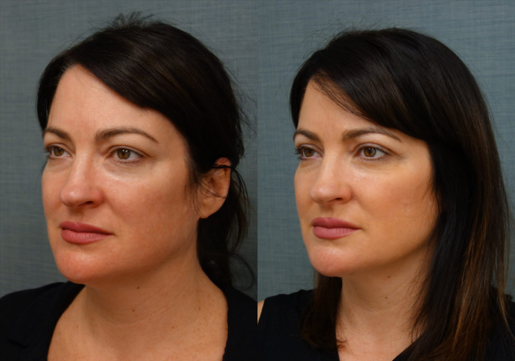 Bilateral Upper Eyelid Blepharoplasty, FaceTite With Micro-Liposuction, Morpheus Microneedling Lower Face Patient 34-C 