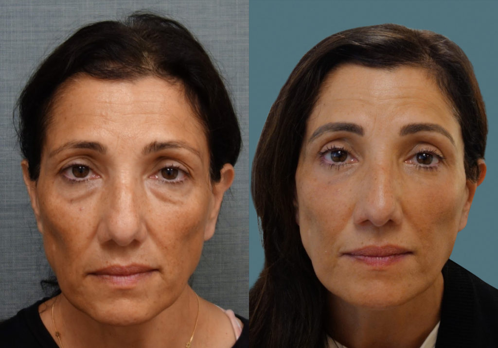 Bilateral Upper and Lower Eyelid Blepharoplasty, Morpheus Microneedling Full Face, Eyelid Laser Resurfacing Patient 34 