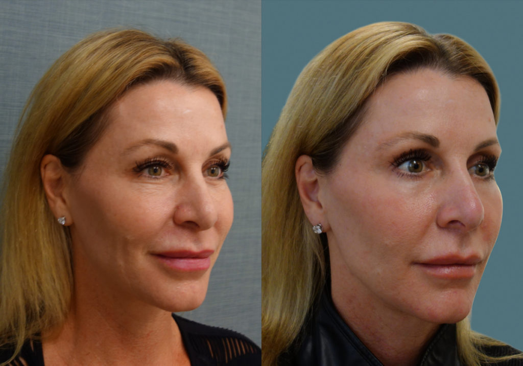 Bilateral Upper and Lower Eyelid Blepharoplasty, Chemical Peel Lower Eyelids Patient 35-B 