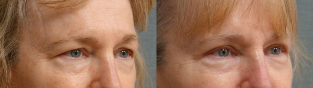 Bilateral Upper Eyelid Blepharoplasty Patient 36-B 