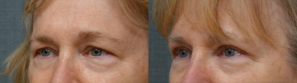 Bilateral Upper Eyelid Blepharoplasty Patient 36-C 