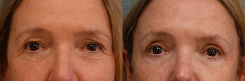 Bilateral Upper Eyelid Blepharoplasty, Bilateral Mini Brow Lift Patient 37-A 