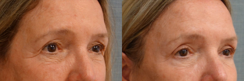 Bilateral Upper Eyelid Blepharoplasty, Bilateral Mini Brow Lift Patient 37-B 