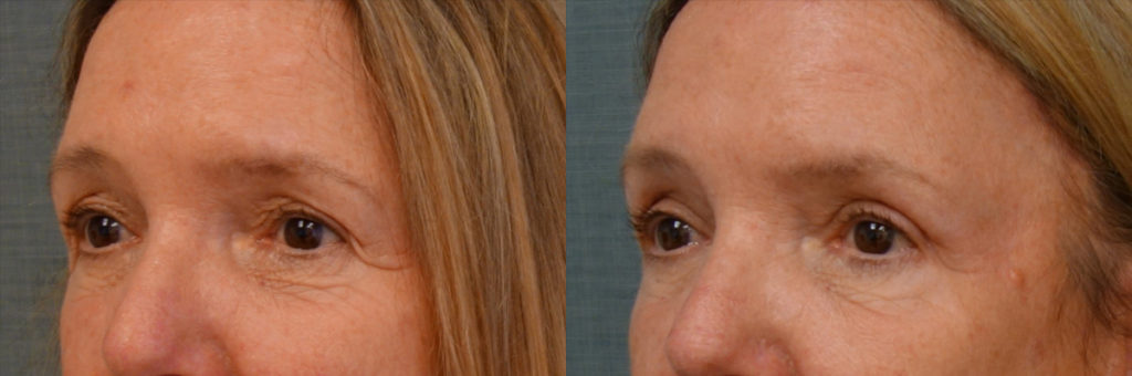 Bilateral Upper Eyelid Blepharoplasty, Bilateral Mini Brow Lift Patient 37-C 